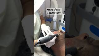 Acne scar treatment  dermabrasion hair laserhairremoval acnescar scartreatment [upl. by Thirion]