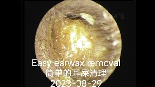 Easy earwax removal简单的耳屎清理20230829 [upl. by Eille275]