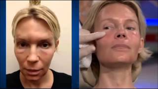 Dr Ourian Demonstrates Fractora  The Mini Face Lift [upl. by Irrol678]