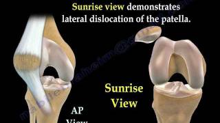 Patellar Dislocations  Everything You Need To Know  Dr Nabil Ebraheim [upl. by Sigrid]