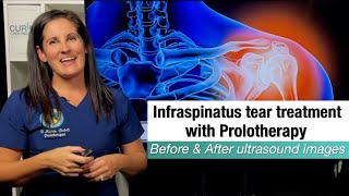 Infraspinatus tear healing with Prolotherapy before amp after ultrasound case presentation [upl. by Yajet]