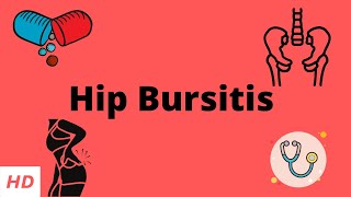 Hip Bursitis Causes Signs and Symptoms Diagnosis and Treatment [upl. by Okiron]