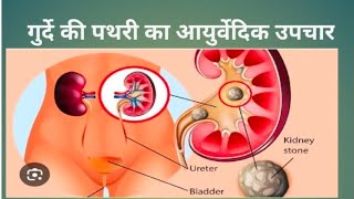 किडनी में कितनी भी भयंकर बड़ी पुरानी पथरी हो healthlytips facts motivation ayush vikas parishad [upl. by Htidra339]