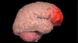 What is a Cerebral Contusion [upl. by Higginbotham]