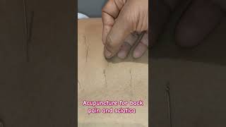 Acupuncture for back pain and sciatica acupuncturists alternativemedicine acupuncturelife pain [upl. by Bowerman122]