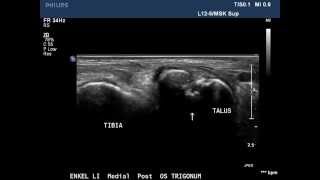 Ultrasound Posterior Ankle Impingement Syndrome Os Trigonum  Drs S Konijnenberg wwwiconenl [upl. by Marthena]