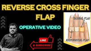 REVERSE CROSS FINGER FLAP COVER [upl. by Auliffe983]