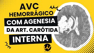 AVC Hemorrágico com Agenesia da Artéria Carótida Interna [upl. by Hodgson]