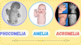 ACROMELIA  PHOCOMELIA  AMELIA  SHORT LIMB ABNORMALITIES  CONGENITAL MALFORMATION [upl. by Charmion837]