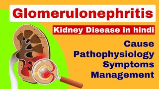 Glomerulonephritis  Nephritis in hindi  kidney disease  medical surgical nursing lecture [upl. by Kutzenco714]