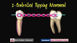 Types of Orthodontic Tooth movement [upl. by Zelle]