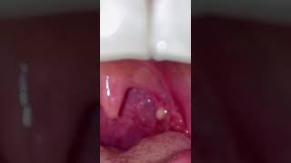 Tonsil Cyst Removal [upl. by Ansaev]