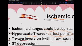 سلسلة الECG المحاضرة 6 Ischemia amp Infarction [upl. by Anicul]