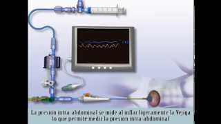 Intraabdominal pressure changes during activities of daily living How much is too much [upl. by Lebatsirc]