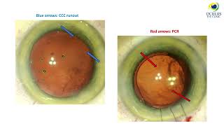 Panoptix IOL implantation in the setting of large PCR  Videocattarattarefrattiva Congress 2024 [upl. by Akimed]