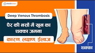 Leg swelling and Deep venous thrombosis DVT  पैर में सूजन और डीप वेनस थ्रोम्बोसिस [upl. by Rosco]