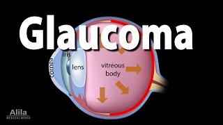 Development of Glaucoma Animation Open Angle vs Angle Closure Glaucoma [upl. by Anirba324]