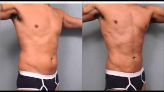 The Benefits of Liposuction for Men  Dr Sterry Explains [upl. by Nilauqcaj600]