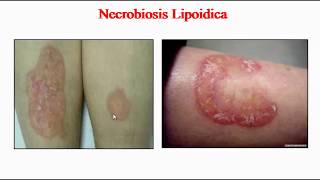 Necrobiosis Lipoidica [upl. by Vahe]