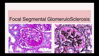 Focal Segmental Glomerulosclerosis FSGS [upl. by Ediva]