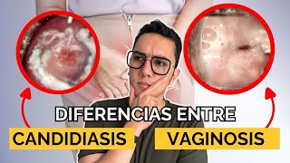 Diferencias entre candidiasis y vaginosis  Dr William Guerrero [upl. by Ecinnaj]