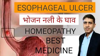 Esophageal Ulcer Symptoms Causes and Treatment  भोजन नली के घाव  Homeopathic Treatment  In Hindi [upl. by Picardi628]