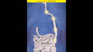 Why is the intestine connected to the food pipe in a stomach tumor [upl. by Ahseenyt]