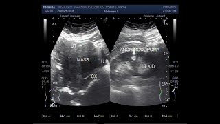 A large Fibroid and a small Renal Angiomyolipoma [upl. by Kall90]