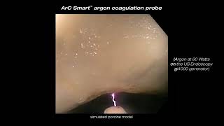 Arc Smart™ Argon Coagulation Probe  Clinical Video [upl. by Layman]