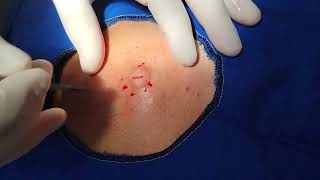 Dorsal Epidermal Cyst Excision [upl. by Olive]