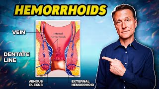 The 1 Best Remedy for Hemorrhoids  Dr Berg [upl. by Senecal]