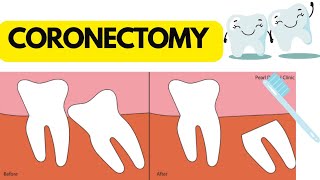 Coronectomy  wisdom tooth  Very easy to learn  Dental dream [upl. by Zaccaria]