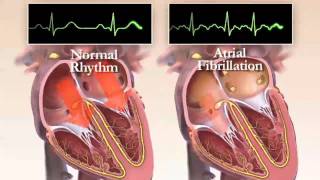 What is Atrial Fibrillation Chapter 1 HRS Patient Video [upl. by Iek460]