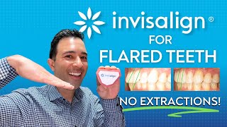 Fix Your Flared Teeth With Invisalign WITHOUT Extractions [upl. by Einattirb]