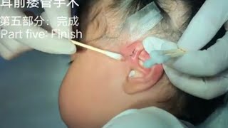 Preauricular Fistula Surgery（Part fiveEnd of surgery）耳前瘘管手术（第五部分：完成）20230815 [upl. by Haveman966]