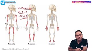 Pagets Disease of Bone Hindi  Orthopedic Lectures [upl. by Urissa]