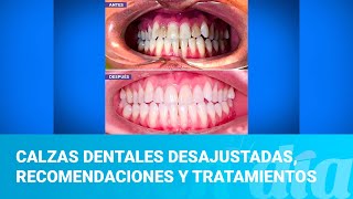 Calzas dentales desajustadas consejos recomendaciones y tratamientos [upl. by Davide]