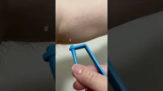 Removing skin tags at home [upl. by Natloz]