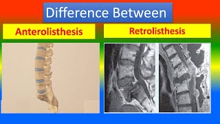 Difference Between Anterolisthesis and Retrolisthesis [upl. by Eseyt647]