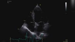 Anomalous coronary ETT Malformação coronária ao ETT [upl. by Ytineres]