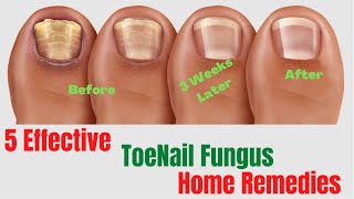 5 Natural Remedies For Toenail Fungus – Toenail Fungus Treatment At Home [upl. by Armilda81]