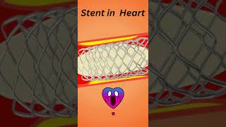 stent heart blockage treatment  stent in heart for blockage shorts heart [upl. by Lacy]