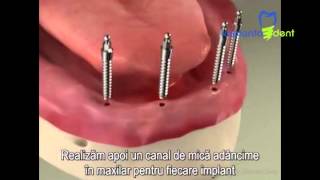 Implants Mini Implant Overdenture Procedure [upl. by Slemmer97]