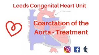 Coarctation of the Aorta  Treatment [upl. by Thema]