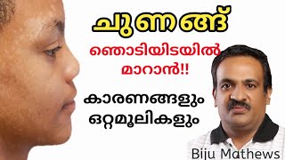 ശരീരത്തിലെ ചുണങ്ങ് അതിവേഗം മാറാന്‍ ചില ഒറ്റമൂലികള്‍  Natural remedies for tinea versicolor [upl. by Adnamas885]