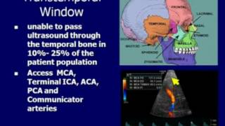 Transcranial Doppler [upl. by Efinnej]