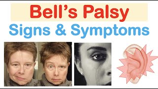 Difference bw facial palsy and Bells palsy [upl. by Annaohj]