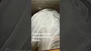 Supraclavicular Brachial Plexus Block nerveblock [upl. by Ydnas]