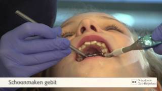 Plaatsen van een Expander Spin beugel  Orthodontie OudBeijerland [upl. by Airehtfele]