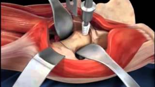 Total Hip Replacement Surgery [upl. by Debor]